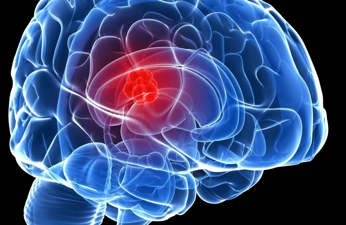 Poznaj najczęstsze objawy guza mózgu.